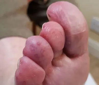 Cold Injury to the Foot When Hiking: Chilblains, Frostbite, and Trench Foot
