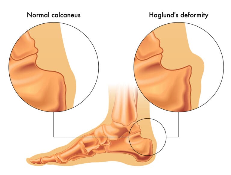 Managing Haglund’s Deformity in Hiking Shoes